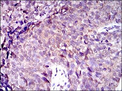 Immunohistochemistry-Paraffin: MRP4/ABCC4 Antibody (2D2A9) [NBP2-37350] - Analysis of cancer tissues using ABCC4 mouse mAb with DAB staining.