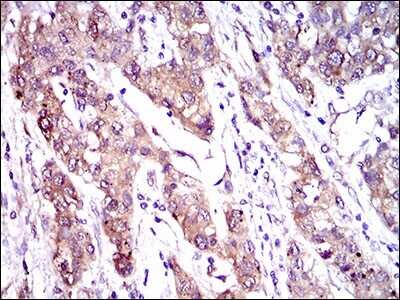 Immunohistochemistry-Paraffin: MRP4/ABCC4 Antibody (6A7H3) [NBP2-37347] - Analysis of  liver cancer tissues using ABCC4 mouse mAb with DAB staining.