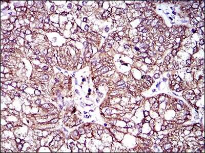 Immunohistochemistry-Paraffin: MRP4/ABCC4 Antibody (6A7H3) [NBP2-37347] - Analysis of esophagus cancer tissues using ABCC4 mouse mAb with DAB staining.