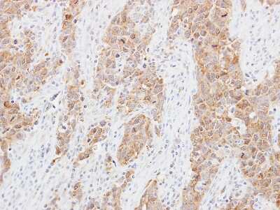 Immunohistochemistry-Paraffin: MRPL1 Antibody [NBP2-19394] - Immunohistochemical analysis of paraffin-embedded Lung ca, using antibody at 1:250 dilution.