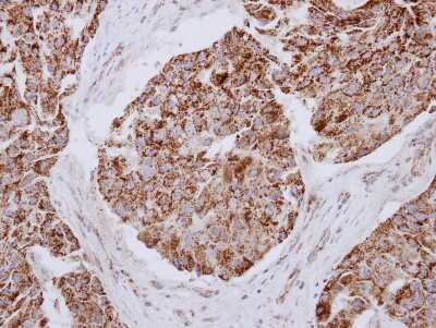 Immunohistochemistry-Paraffin: MRPL12 Antibody [NBP2-19397] - Immunohistochemical analysis of paraffin-embedded Breast ca, using antibody at 1:250 dilution.