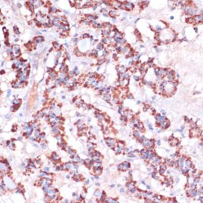 Immunohistochemistry-Paraffin: MRPL23 Antibody [NBP2-94112] - Human thyroid cancer using MRPL23 antibody at dilution of 1:100 (40x lens).