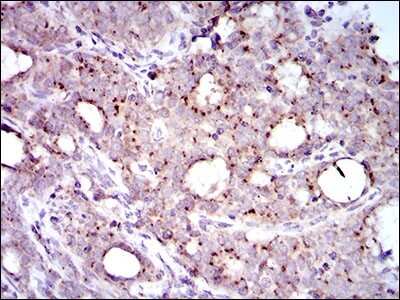 Immunohistochemistry: MRPL42 Antibody (3H6G11) [NBP2-37393] - Immunohistochemical analysis of paraffin-embedded cervical cancer tissues using MRPL42 mouse mAb with DAB staining.