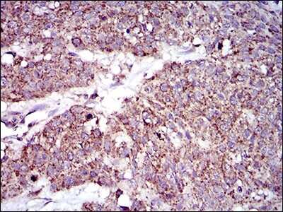 Immunohistochemistry: MRPL42 Antibody (3H6G11) [NBP2-37393] - Immunohistochemical analysis of paraffin-embedded esophageal cancer tissues using MRPL42 mouse mAb with DAB staining.