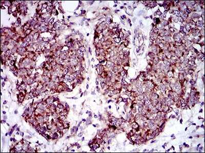 Immunohistochemistry: MRPL42 Antibody (3H6H2) [NBP2-37385] - Immunohistochemical analysis of paraffin-embedded breast cancer tissues using MRPL42 mouse mAb with DAB staining.