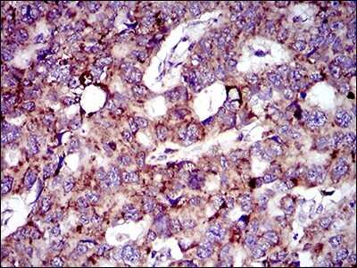 Immunohistochemistry: MRPL42 Antibody (3H6H2) [NBP2-37385] - Immunohistochemical analysis of paraffin-embedded esophageal cancer tissues using MRPL42 mouse mAb with DAB staining.