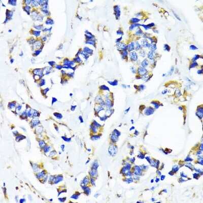 Immunohistochemistry-Paraffin: MRPL45 Antibody [NBP2-93711] - Paraffin-embedded human breast cancer using MRPL45 .