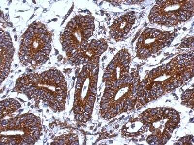 Immunohistochemistry-Paraffin: MRPS18B Antibody [NBP2-15024] - Paraffin-embedded Colon ca, using antibody at 1:500 dilution.