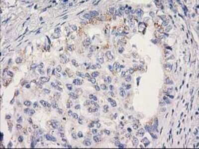 Immunohistochemistry-Paraffin: MRPS2 Antibody (4D6) [NBP2-03292] Staining of paraffin-embedded Carcinoma of Human lung tissue using anti-MRPS2 mouse monoclonal antibody.