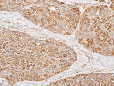 Immunohistochemistry-Paraffin: MRPS22 Antibody [NBP1-31568] - Paraffin-embedded LUNG SCC, using antibody at 1:300 dilution.