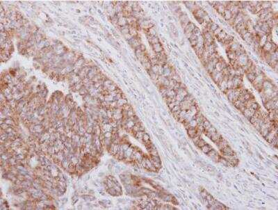 Immunohistochemistry-Paraffin: MRPS23 Antibody [NBP2-19410] -  Paraffin-embedded colon carcinoma. MRPS23 antibody  dilution: 1:250.