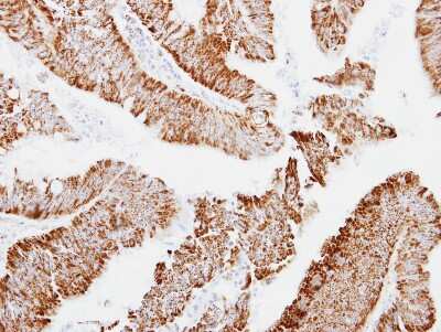 Immunohistochemistry-Paraffin: MRPS23 Antibody [NBP2-19411] - Immunohistochemical analysis of paraffin-embedded Colon ca, using antibody at 1:250 dilution.