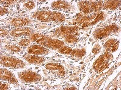 Immunohistochemistry-Paraffin: MRPS23 Antibody [NBP2-19412] - MRPS23 antibody detects MRPS23 protein at cytosol on colon carcinoma by immunohistochemical analysis. Sample: Paraffin-embedded colon carcinoma. MRPS23 antibody dilution: 1:500.
