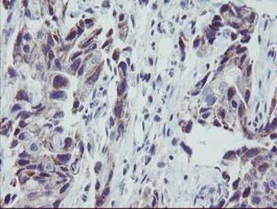 Immunohistochemistry: MRPS27 Antibody (OTI1A2) - Azide and BSA Free [NBP2-72784] - Staining of paraffin-embedded Adenocarcinoma of Human breast tissue using anti-MRPS27 mouse monoclonal antibody.