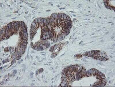 Immunohistochemistry: MRPS27 Antibody (OTI6E5) [NBP2-45938] - Analysis of Adenocarcinoma of Human colon tissue.