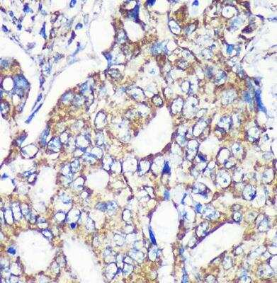 Immunohistochemistry-Paraffin: MRPS35 Antibody [NBP2-94003] - Human colon carcinoma using MRPS35 Rabbit pAb at dilution of 1:100 (40x lens).