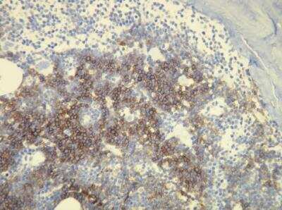 Immunohistochemistry-Paraffin: MS4A1/CD20 Antibody (E17-P) [NBP1-30144] - Chronic lymphocytic leukaemia cells in the bone marrow biopsy, showing CD20 expression.Formalin fixed, paraffin embedded human tissues (4 um sections) stained with anti- CD20 monospecific clonal antibody.