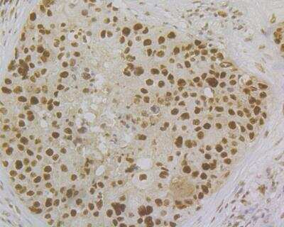Immunohistochemistry: MSH2 Antibody (10G1) [NBP2-76895] - Immunohistochemical analysis of paraffin-embedded human breast cancer tissue using anti-MSH2 antibody. Counter stained with hematoxylin. The section was pre-treated using heat mediated antigen retrieval with sodium citrate buffer (pH6) for 20 mins.