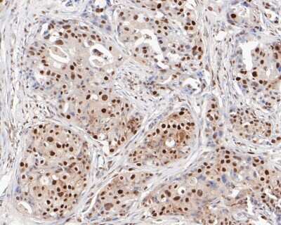 Immunohistochemistry-Paraffin: MSH2 Antibody (10G1) [NBP2-76895] - Immunohistochemical analysis of paraffin-embedded human breast carcinoma tissue using anti-MSH2 antibody. The section was pre-treated using heat mediated antigen retrieval with sodium citrate buffer (pH 6.0) for 20 minutes. The tissues were blocked in 5%