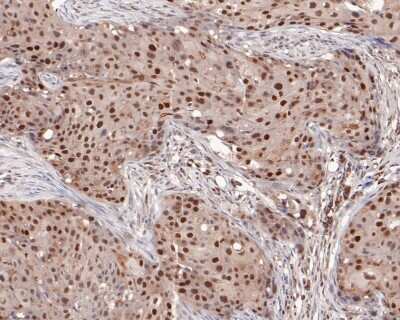 Immunohistochemistry-Paraffin: MSH2 Antibody (10G2) [NBP2-76896] - Immunohistochemical analysis of paraffin-embedded human breast carcinoma tissue using anti-MSH2 antibody. The section was pre-treated using heat mediated antigen retrieval with sodium citrate buffer (pH 6.0) for 20 minutes. The tissues were blocked in 5%