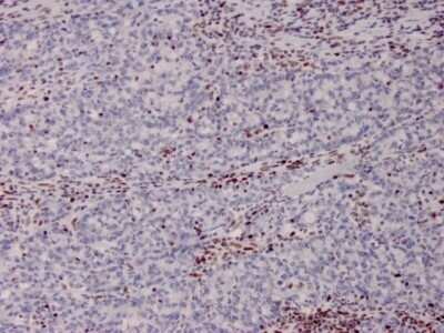 Immunohistochemistry-Paraffin: MSH2 Antibody (MSH2/2622) - Azide and BSA Free [NBP3-08957] - Formalin-fixed, paraffin-embedded human Colon from Lynch disease stained with MSH2 Mouse Monoclonal Antibody (MSH2/2622).