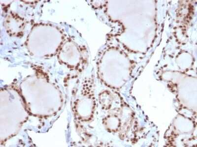 Immunohistochemistry-Paraffin: MSH2 Antibody (MSH2/2622) - Azide and BSA Free [NBP3-08957] - Formalin-fixed, paraffin-embedded human Thyroid Carcinoma stained with MSH2 Mouse Monoclonal Antibody (MSH2/2622).