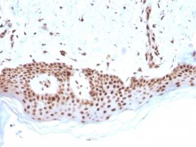 Immunohistochemistry-Paraffin: MSH2 Antibody (MSH2/2622) - Azide and BSA Free [NBP3-08957] - Formalin-fixed, paraffin-embedded human Basal Cell Carcinoma stained with MSH2 Mouse Monoclonal Antibody (MSH2/2622).