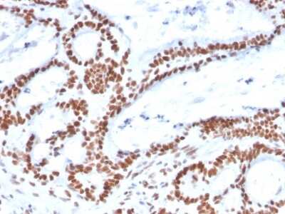 Immunohistochemistry-Paraffin: MSH2 Antibody (MSH2/2622) - Azide and BSA Free [NBP3-08957] - Formalin-fixed, paraffin-embedded human Colon Carcinoma stained with MSH2 Mouse Monoclonal Antibody (MSH2/2622).
