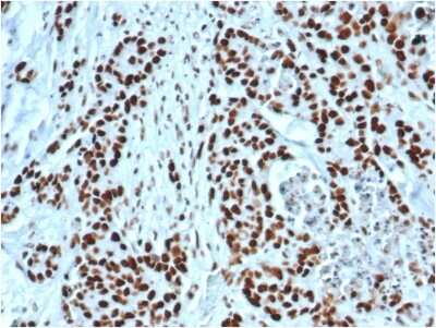 Immunohistochemistry-Paraffin: MSH2 Antibody (MSH2/6549R) - Azide and BSA Free [NBP3-08958] - Formalin-fixed, paraffin-embedded human colon stained with MSH2 Recombinant Rabbit Monoclonal Antibody (MSH2/6549R).