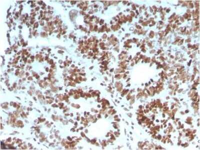 Immunohistochemistry-Paraffin: MSH6 Antibody (MSH6/3086) - Azide and BSA Free [NBP2-79846] - Formalin-fixed, paraffin-embedded human Colon Carcinoma stained with MSH6 Antibody (MSH6/3086).