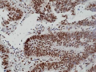 Immunohistochemistry: MSH6 Antibody (RM376) [NBP2-77434] - Immunohistochemical staining of formalin fixed and paraffin embedded human colon cancer tissue section using NBP2-77434.