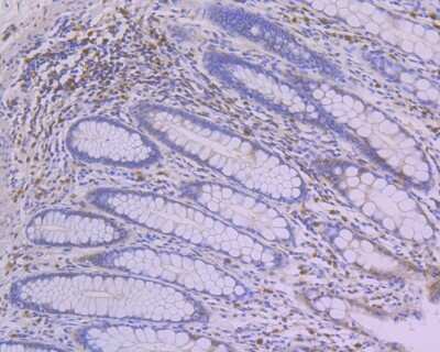 Immunohistochemistry-Paraffin: MSK1/RPS6KA5 [p Ser376] Antibody (SN63-05) [NBP2-67653] - Immunohistochemical analysis of paraffin-embedded human colon tissue using anti-MSK1/RPS6KA5 antibody. The section was pre-treated using heat mediated antigen retrieval with Tris-EDTA buffer (pH 8.0-8.4) for 20 minutes. The tissues were blocked in 5% BSA for 30 minutes at room temperature, washed with ddH2O and PBS, and then probed with the primary antibody (1/50) for 30 minutes at room temperature. The detection was performed using an HRP conjugated compact polymer system. DAB was used as the chromogen. Tissues were counterstained with hematoxylin and mounted with DPX.