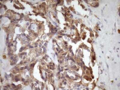 Immunohistochemistry: MSP/MST1 Antibody (OTI1A10) - Azide and BSA Free [NBP2-72792] - Analysis of Adenocarcinoma of Human breast tissue . (Heat-induced epitope retrieval by Tris-EDTA, pH8.0)