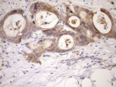 Immunohistochemistry: MSP/MST1 Antibody (OTI1A10) - Azide and BSA Free [NBP2-72792] - Analysis of Adenocarcinoma of Human colon tissue. (Heat-induced epitope retrieval by Tris-EDTA, pH8.0)