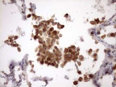 Immunohistochemistry: MSP/MST1 Antibody (OTI1A10) - Azide and BSA Free [NBP2-72792] - Analysis of Carcinoma of Human lung tissue. (Heat-induced epitope retrieval by Tris-EDTA, pH8.0)