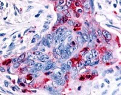 Immunohistochemistry-Paraffin: MSP R/Ron Antibody [NLS7186] - IHC analysis of Colon Carcinoma using NLS7186 at 4 ug/ ml.