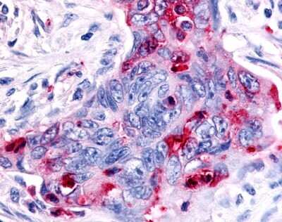 Immunohistochemistry-Paraffin: MSP R/Ron Antibody [NLS7186] - Analysis of anti-MST1R / RON antibody with human colon carcinoma at 4 ug/ml.