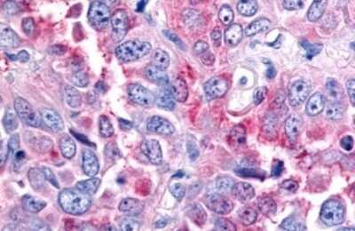 Immunohistochemistry-Paraffin: MSP R/Ron Antibody [NLS7186] - Anti-MST1R / RON antibody IHC of human Lung, Non-Small Cell Carcinoma. Immunohistochemistry of formalin-fixed, paraffin-embedded tissue after heat-induced antigen retrieval.
