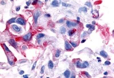 Immunohistochemistry-Paraffin: MSP R/Ron Antibody [NLS7186] - Anti-MST1R / RON antibody IHC of human Pancreas, Carcinoma. Immunohistochemistry of formalin-fixed, paraffin-embedded tissue after heat-induced antigen retrieval.