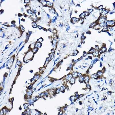 Immunohistochemistry-Paraffin: MSRB2 Antibody [NBP2-94608] - Human lung cancer using MSRB2 Rabbit pAb (NBP2-94608) at dilution of 1:200 (40x lens). Perform high pressure antigen retrieval with 10 mM citrate buffer pH 6.0 before commencing with IHC staining protocol.