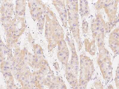Immunohistochemistry-Paraffin: MSRB2 Antibody [NBP2-99224] - Immunochemical staining of human MSRB2 in human hepatoma with rabbit polyclonal antibody at 1:200 dilution, formalin-fixed paraffin embedded sections.