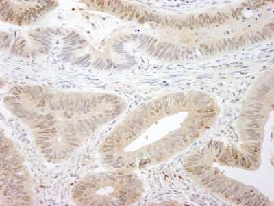 Immunohistochemistry-Paraffin: MST1/2 Antibody [NBP1-28672] - Section of human colon carcinoma. Antibody: Affinity purified rabbit antiMST1,2/STK3,4 used at a dilution of 1:250. Detection: DAB