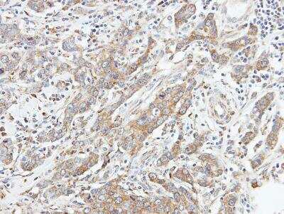 Immunohistochemistry-Paraffin: MST2/STK3 Antibody [NBP1-32313] - Paraffin-embedded GASTRIC CA, using antibody at 1:100 dilution.