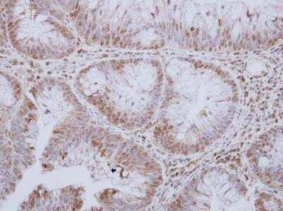 Immunohistochemistry-Paraffin: MST3 Antibody [NBP1-31360] - Paraffin-embedded human breast carcinoma. STK24 antibody [N2C1], Internal dilution: 1:250.