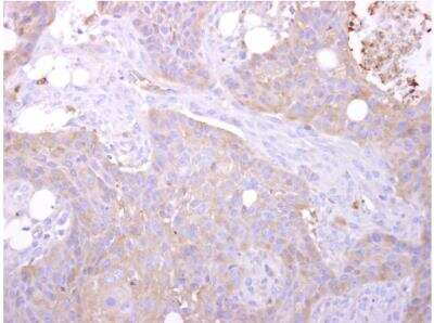 Immunohistochemistry-Paraffin: MST3 Antibody [NBP1-31575] - Sample: Paraffin-embedded HSC-3 xenograft. STK24 antibody dilution: 1:500.