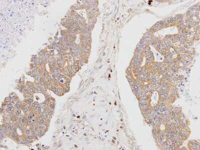 Immunohistochemistry-Paraffin: MSTO1 Antibody [NBP1-32254] - Paraffin-embedded OVCA xenograft, using antibody at 1:100 dilution.