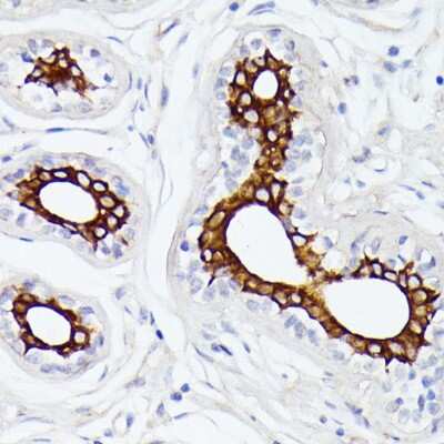 Immunohistochemistry-Paraffin: MT-ND5 Antibody [NBP3-05604] - Human breast cancer using MT-ND5 antibody (NBP3-05604) at dilution of 1:100 (40x lens).