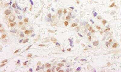 Immunohistochemistry-Paraffin: MTA3 Antibody [NB100-2306] - Sample: FFPE section of human breast carcinoma. Antibody: Affinity purified rabbit anti- MTA3 used at a dilution of 1:1,000 (1ug/ml). Detection: DAB