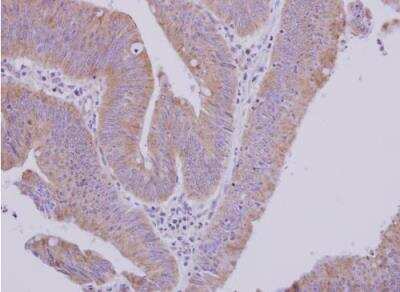 Immunohistochemistry-Paraffin: MTBP Antibody [NBP2-19427] - Human colon carcinoma.  MTBP antibody [N1N3] dilution: 1:500. Antigen Retrieval: Trilogy™ (EDTA based, pH 8.0) buffer, 15min