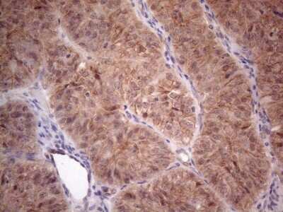 Immunohistochemistry: MTF1 Antibody (2F3) [NBP2-46027] - Analysis of Adenocarcinoma of Human ovary tissue. (Heat-induced epitope retrieval by 1mM EDTA in 10mM Tris buffer (pH8.5) at 120C for 3 min)